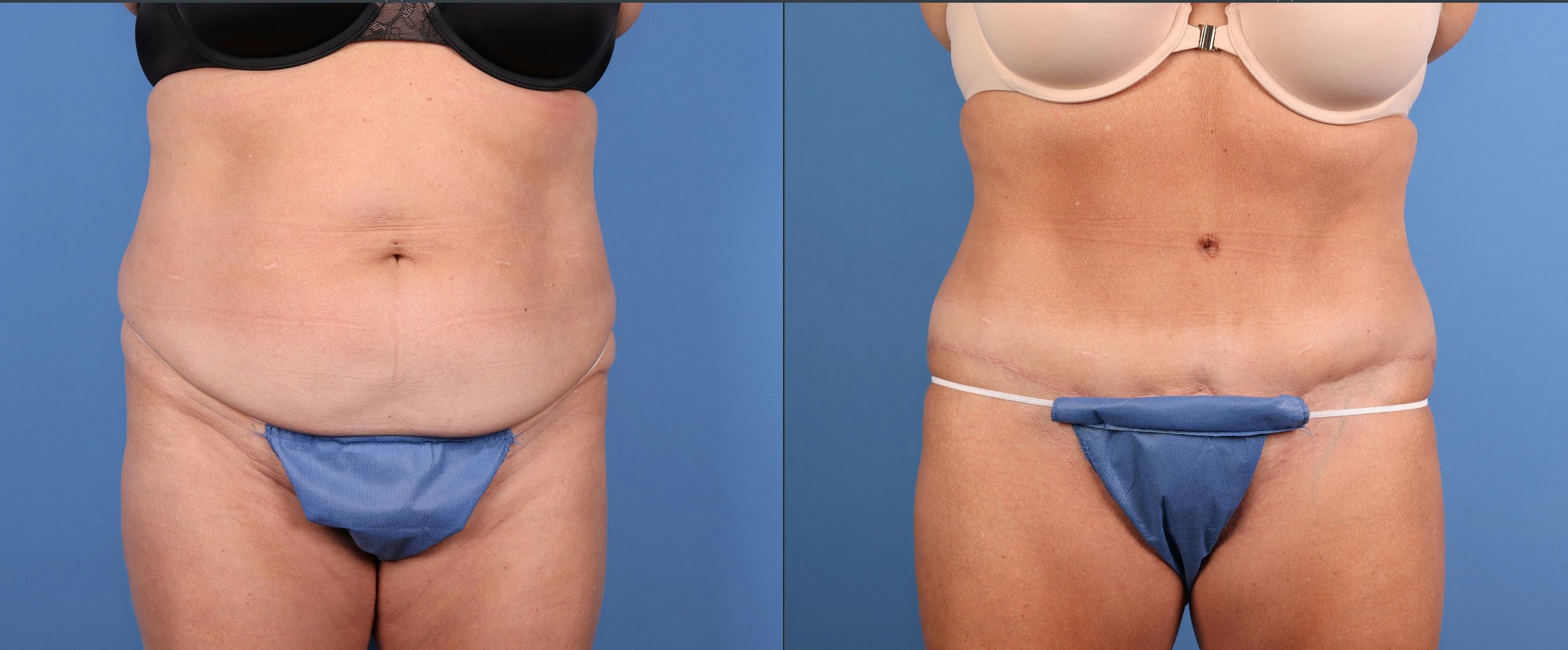 Tummy Tuck Before & After Gallery - Patient 118227 - Image 1