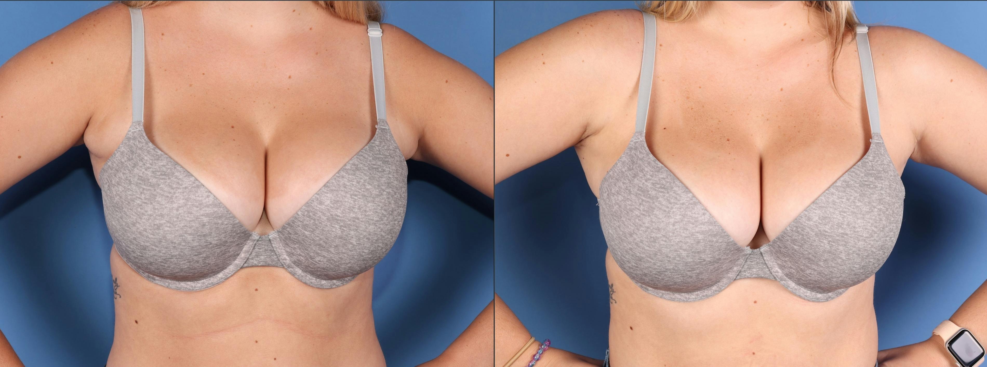 Breast Reduction Before & After Gallery - Patient 244025 - Image 1