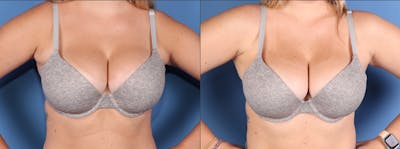 Breast Reduction Before & After Gallery - Patient 244025 - Image 1