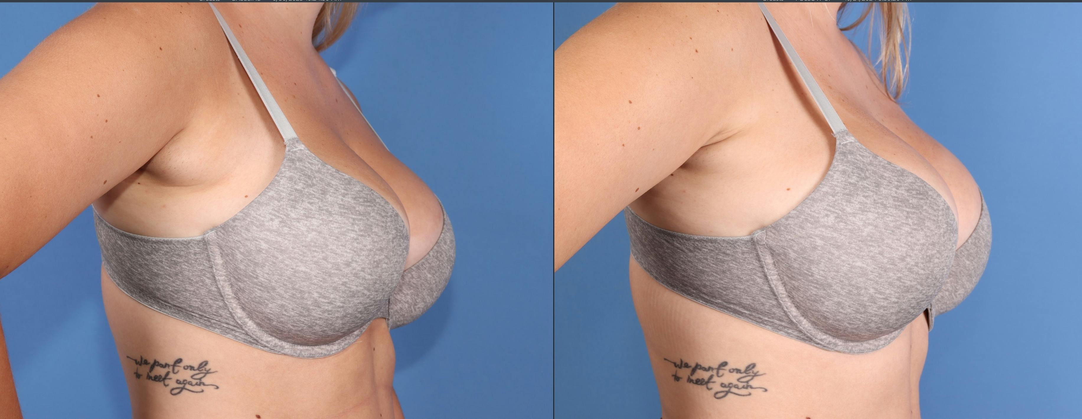 Breast Reduction Before & After Gallery - Patient 244025 - Image 2