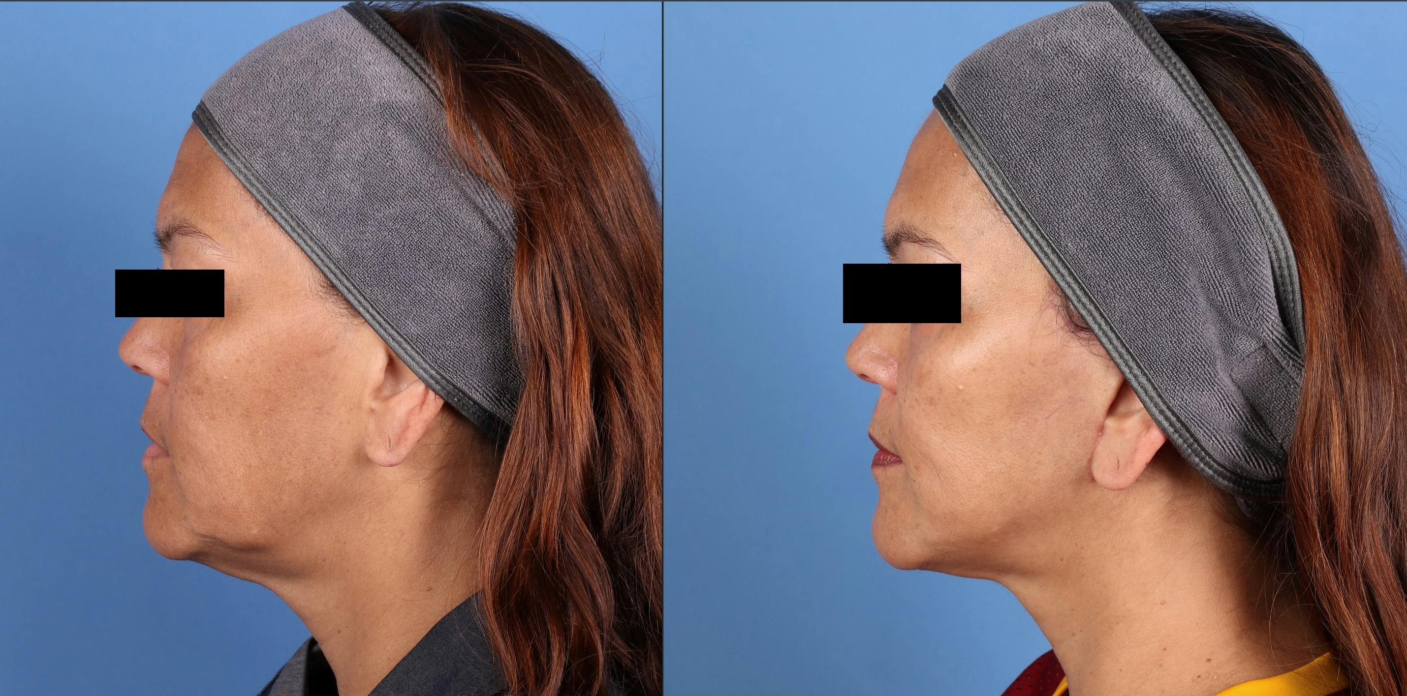 Mini Facelift Before & After Gallery - Patient 218563 - Image 3
