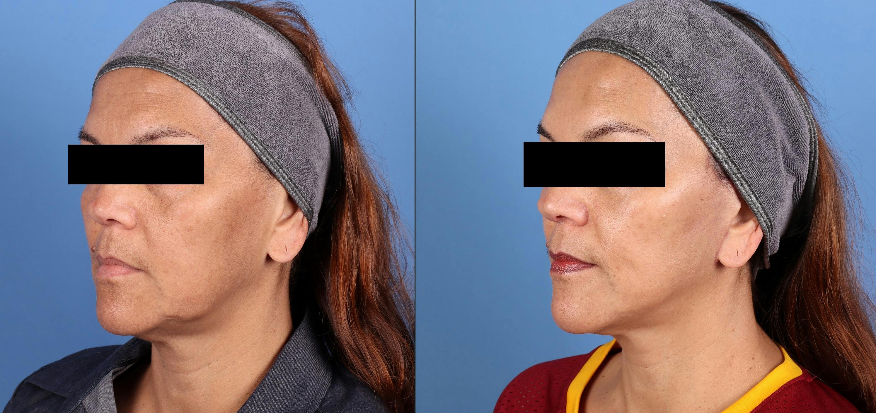 Mini Facelift Before & After Gallery - Patient 218563 - Image 2