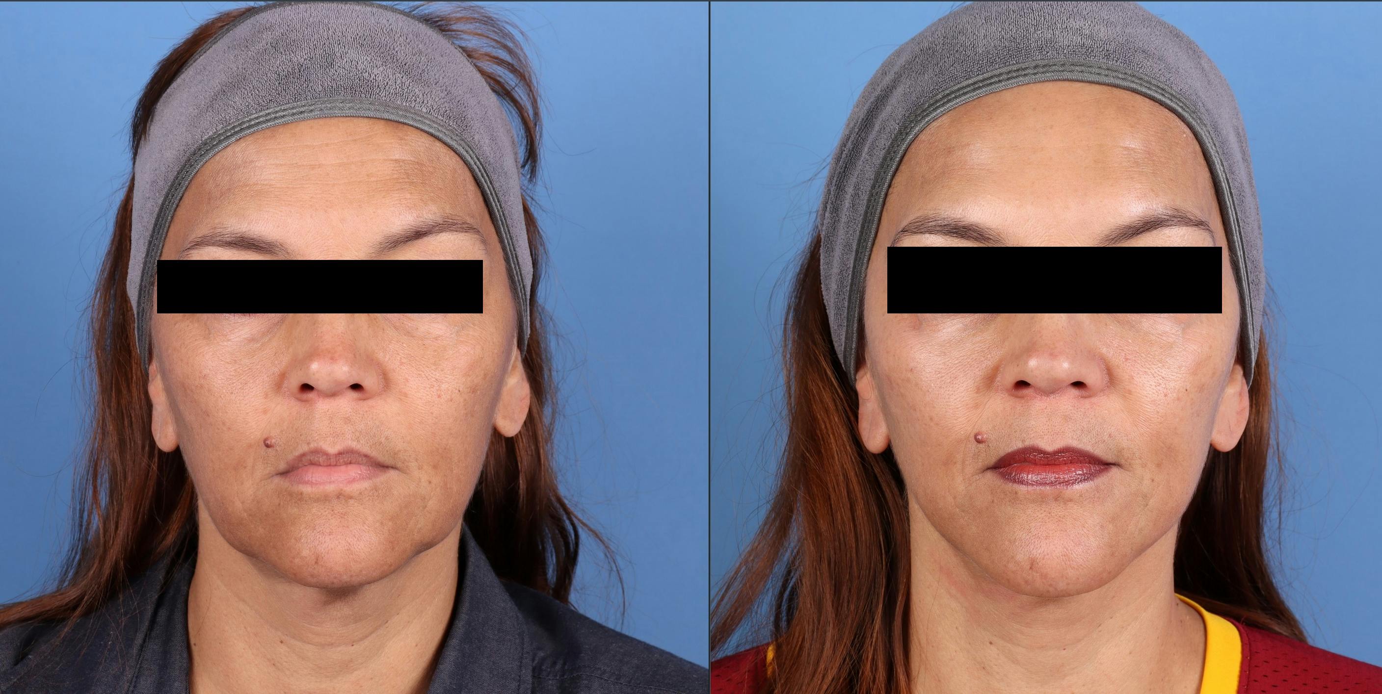 Mini Facelift Before & After Gallery - Patient 218563 - Image 1