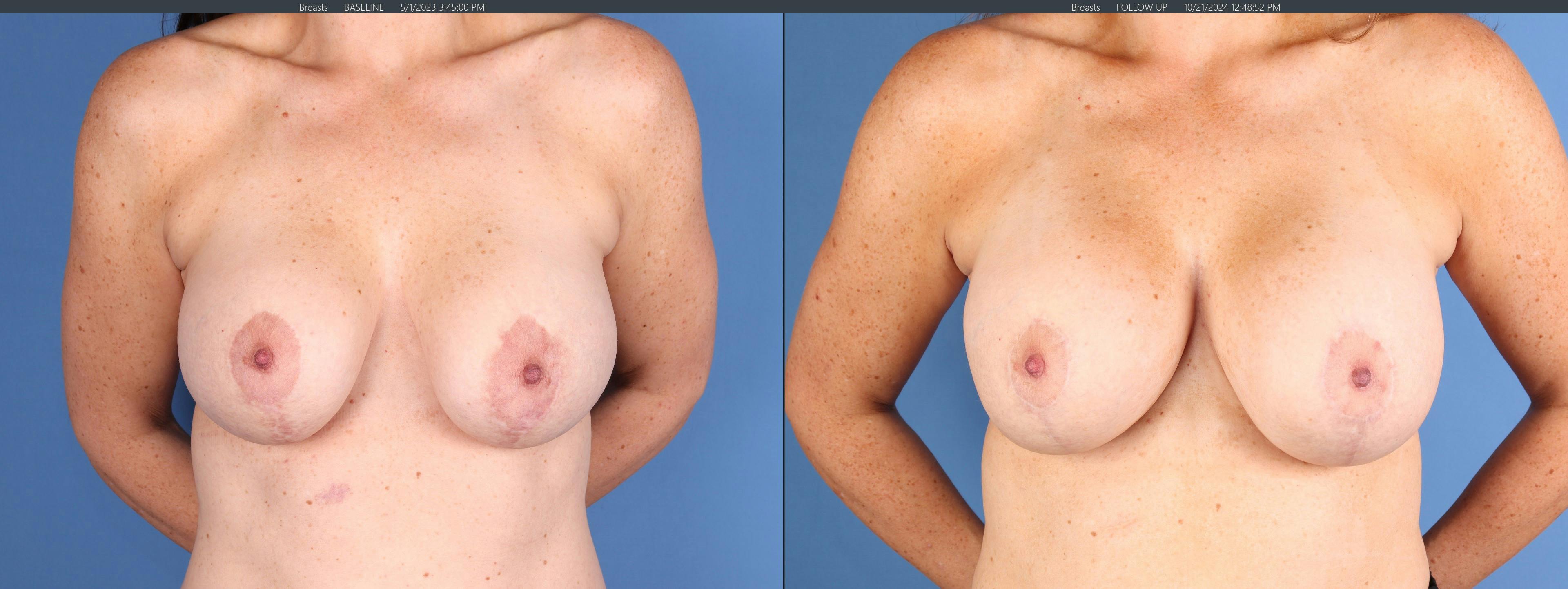 Breast Revision Before & After Gallery - Patient 349613 - Image 1
