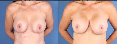 Breast Revision Before & After Gallery - Patient 349613 - Image 1
