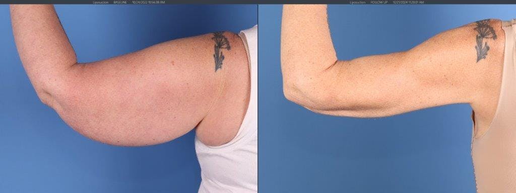 Arm Lift Before & After Gallery - Patient 588435 - Image 4