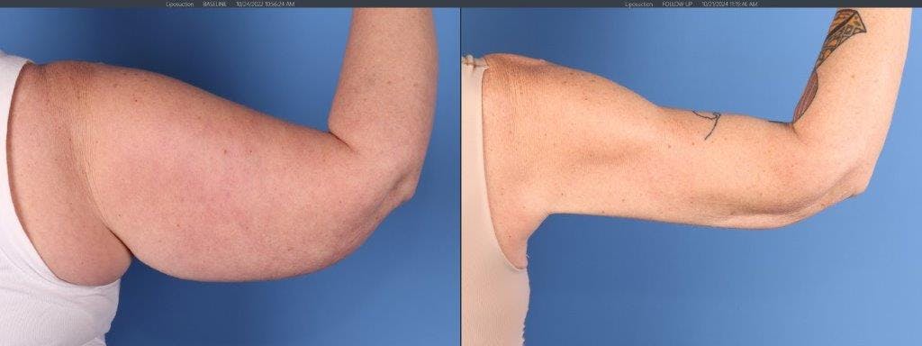 Arm Lift Before & After Gallery - Patient 588435 - Image 2