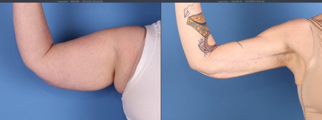 Arm Lift Before & After Gallery - Patient 588435 - Image 3