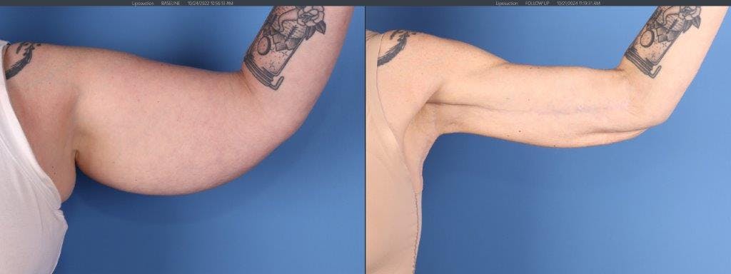 Arm Lift Before & After Gallery - Patient 588435 - Image 1