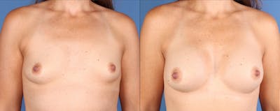 Breast Augmentation Before & After Gallery - Patient 111032 - Image 1