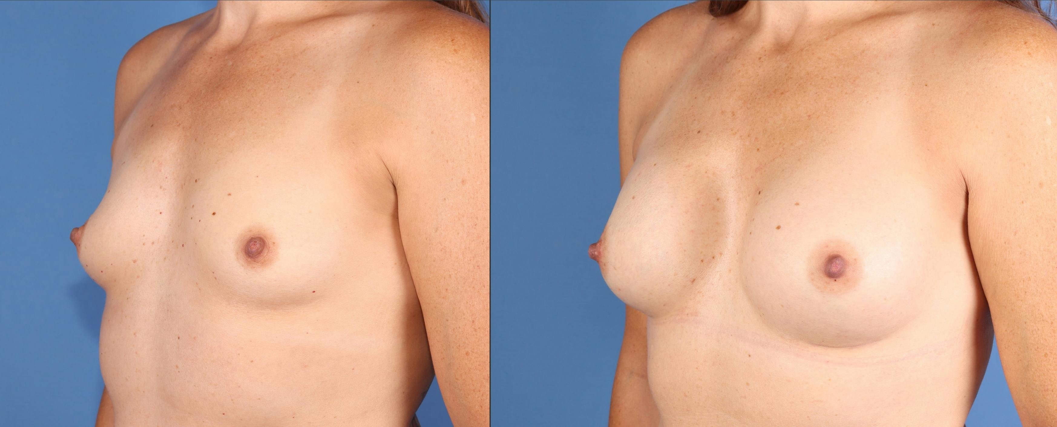 Breast Augmentation Before & After Gallery - Patient 111032 - Image 2