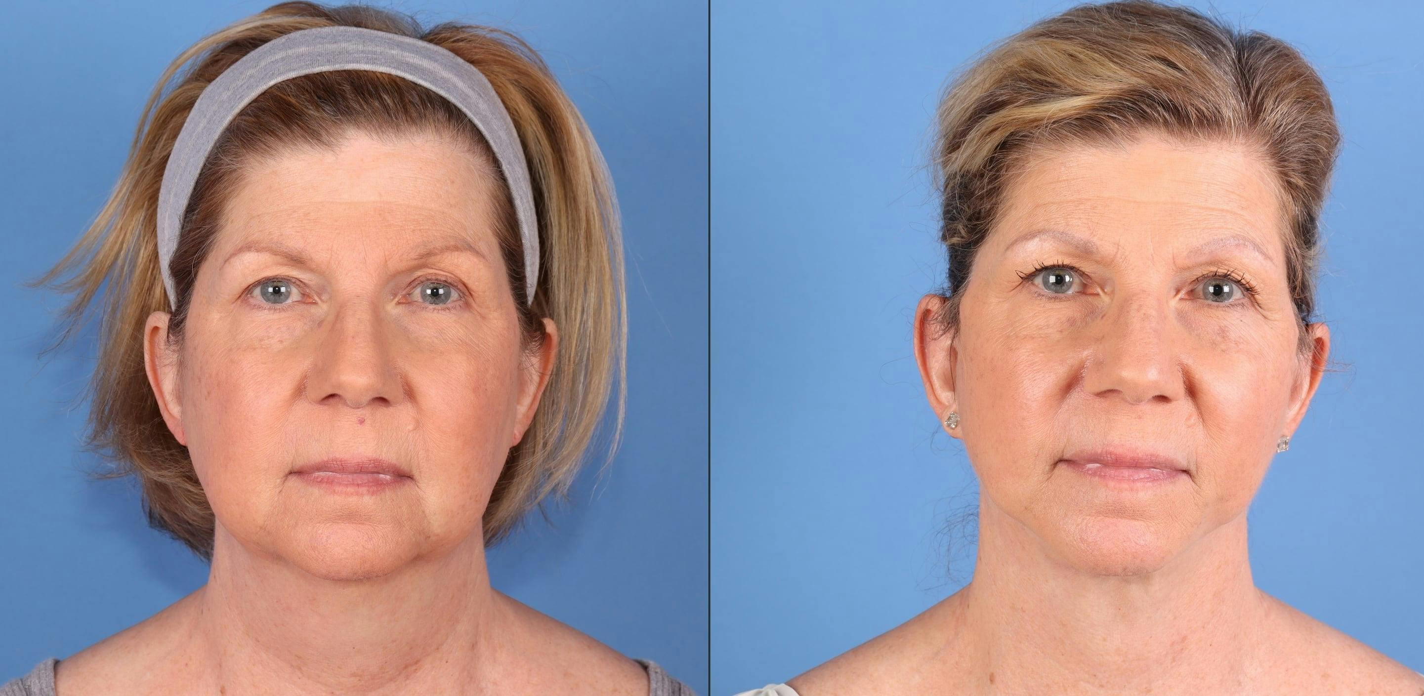 Facelift
