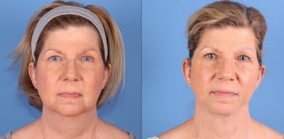 Face Lift Before & After Gallery - Patient 426688 - Image 1