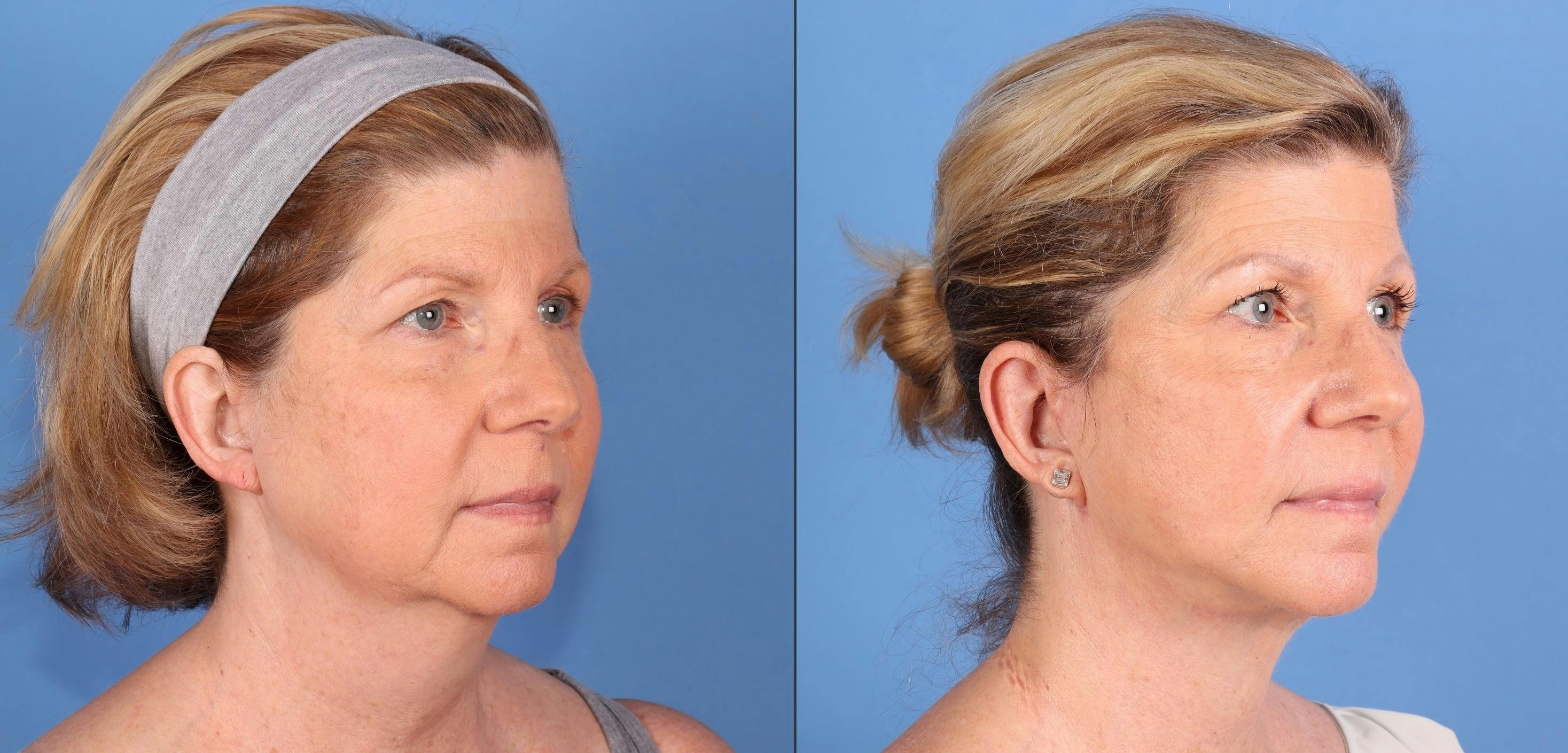 Neck Lift Before & After Gallery - Patient 145579 - Image 3