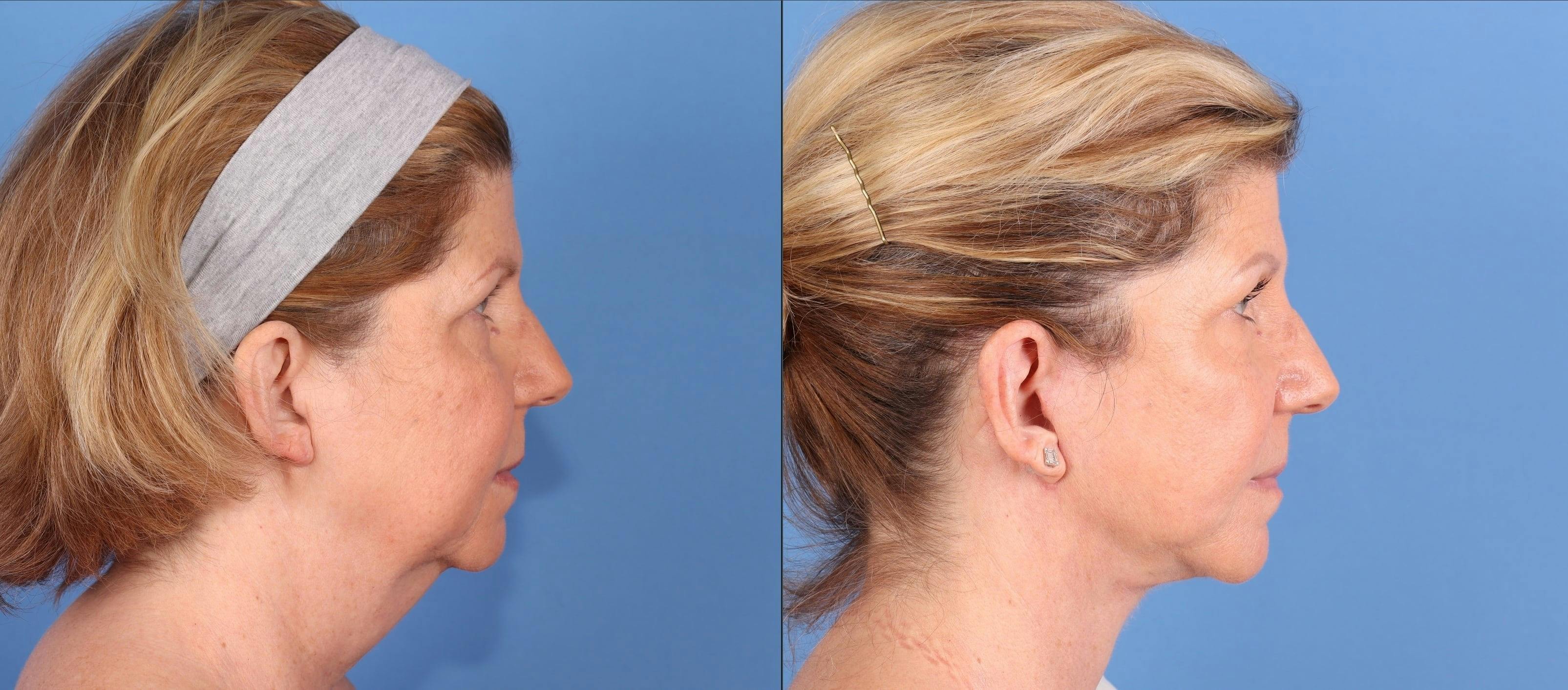 Neck Lift Before & After Gallery - Patient 145579 - Image 1