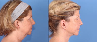 Neck Lift Before & After Gallery - Patient 145579 - Image 1