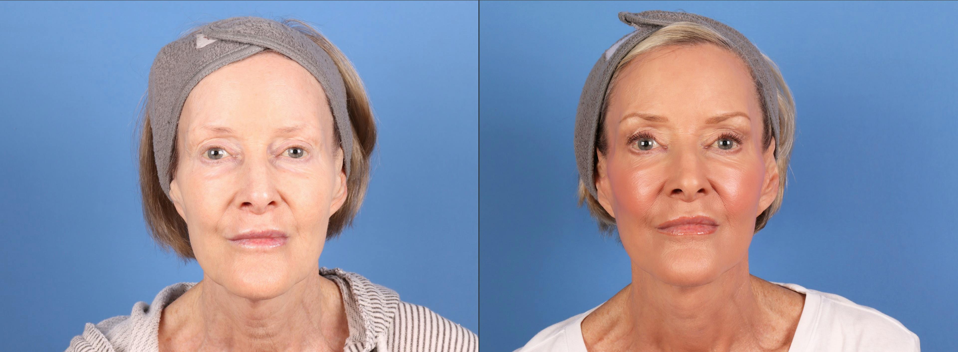 Facelift