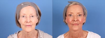 Face Lift Before & After Gallery - Patient 795071 - Image 1