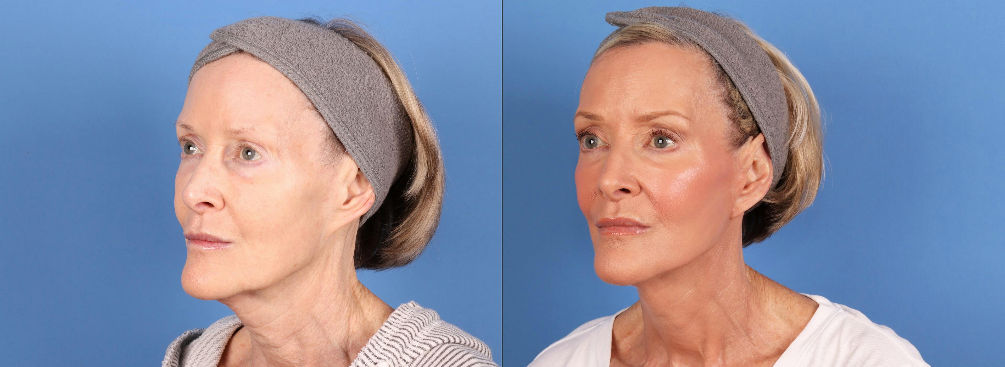 Neck Lift Before & After Gallery - Patient 398805 - Image 2