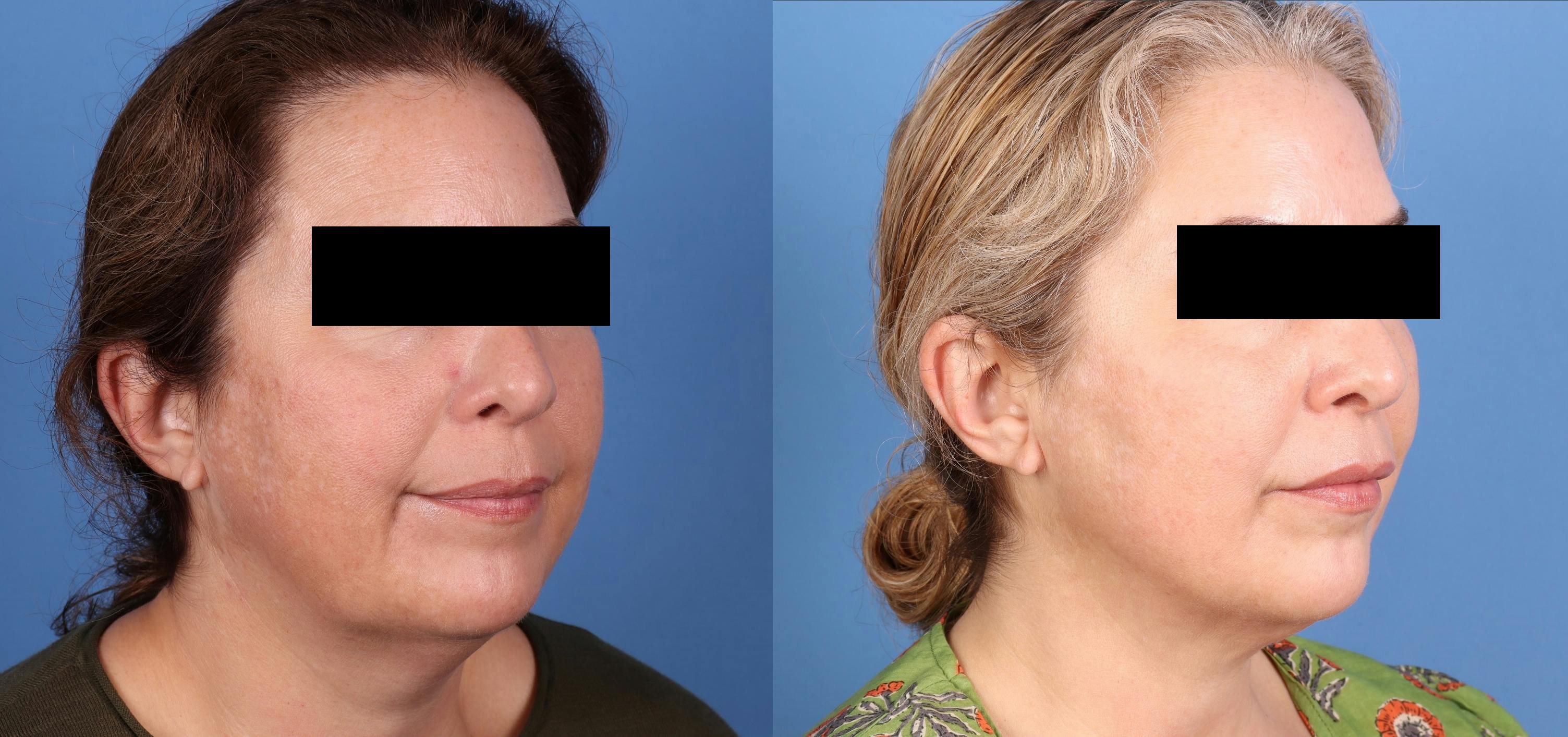Neck Lift Before & After Gallery - Patient 593003 - Image 2