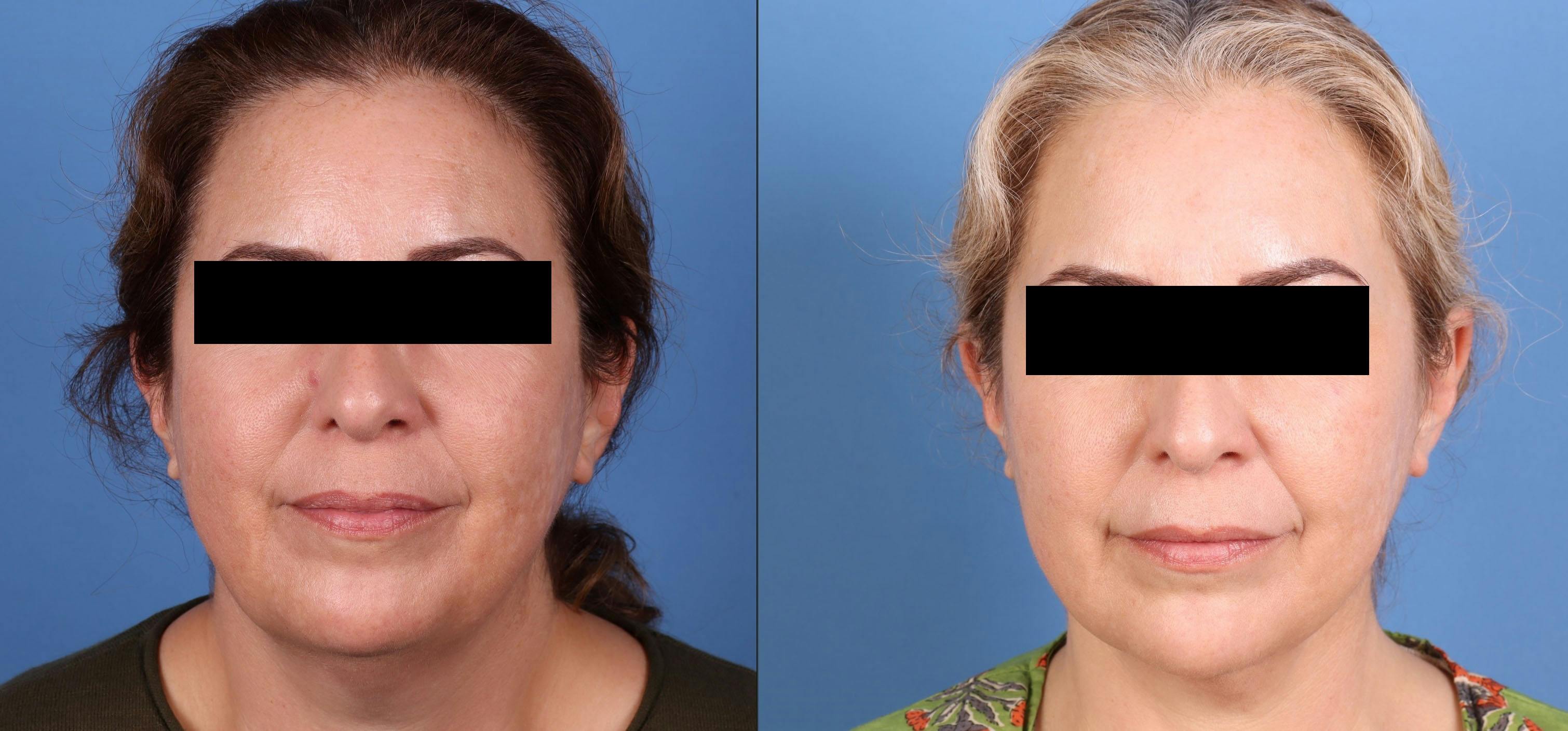 Neck Lift Before & After Gallery - Patient 593003 - Image 3