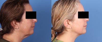 Neck Lift Before & After Gallery - Patient 593003 - Image 1