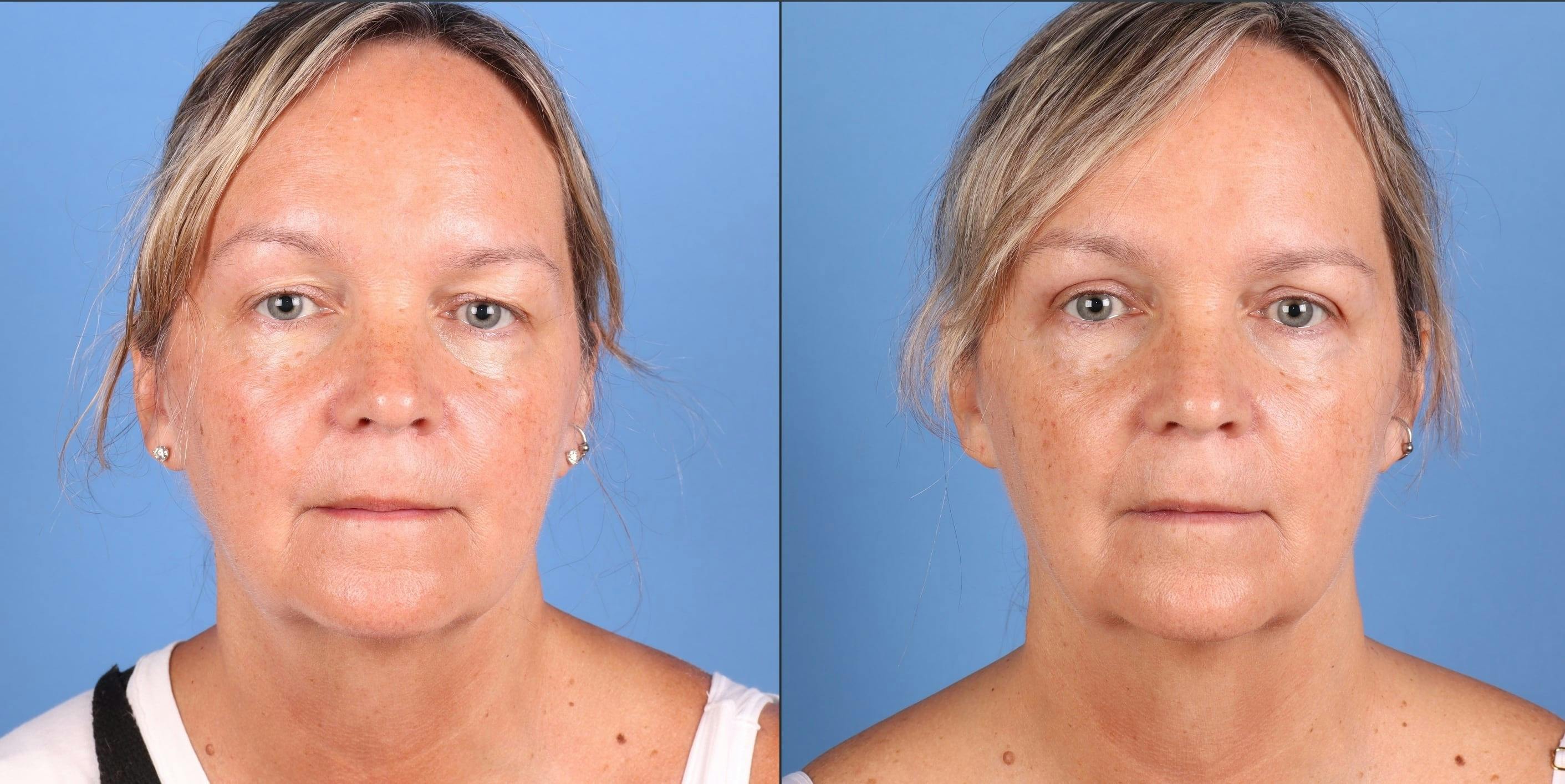 Eyelid Surgery (Upper Blepharoplasty) Before & After Gallery - Patient 178096 - Image 1