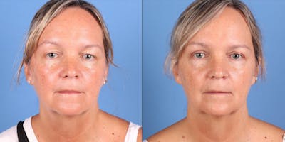 Eyelid Surgery (Upper Blepharoplasty) Before & After Gallery - Patient 178096 - Image 1