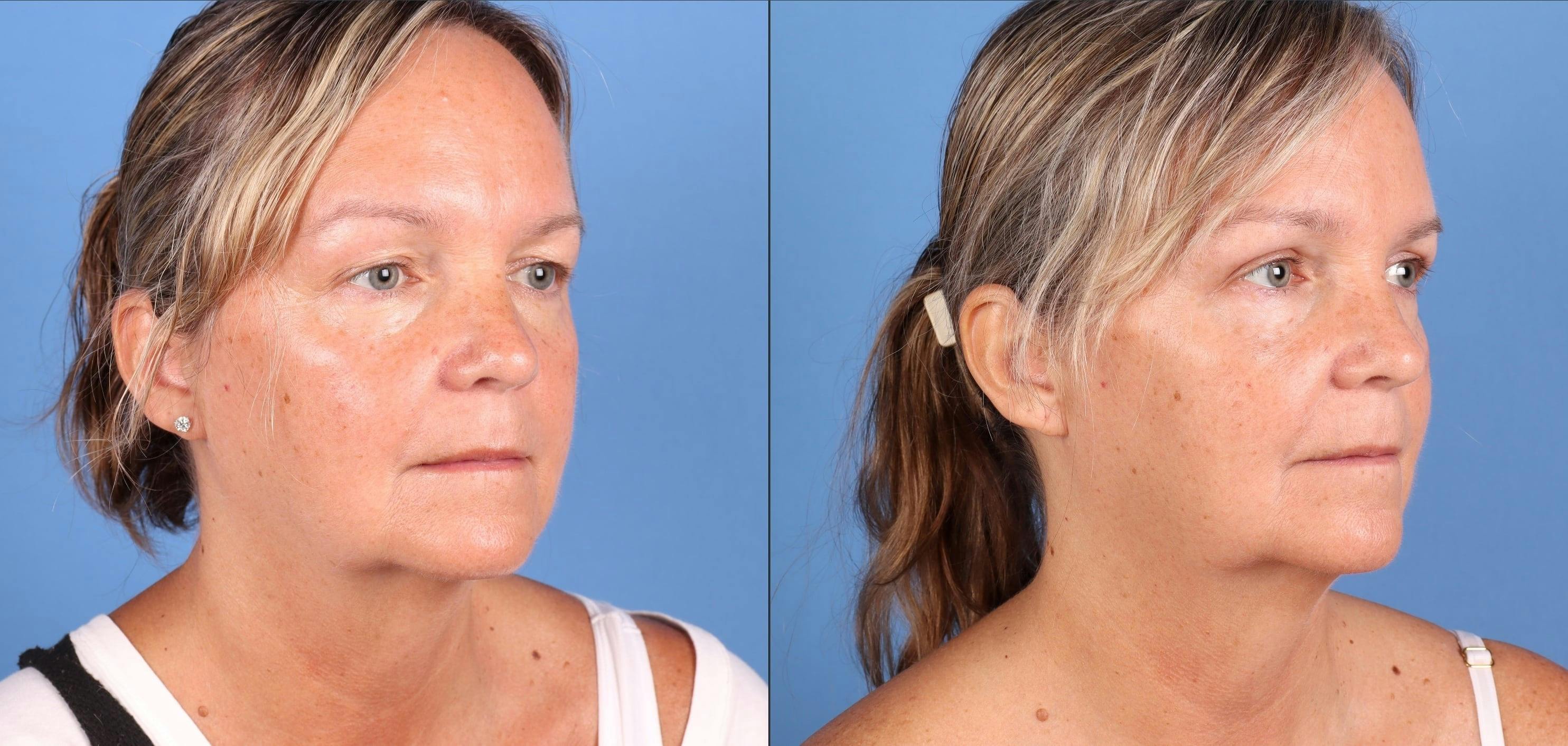 Eyelid Surgery (Upper Blepharoplasty) Before & After Gallery - Patient 178096 - Image 2