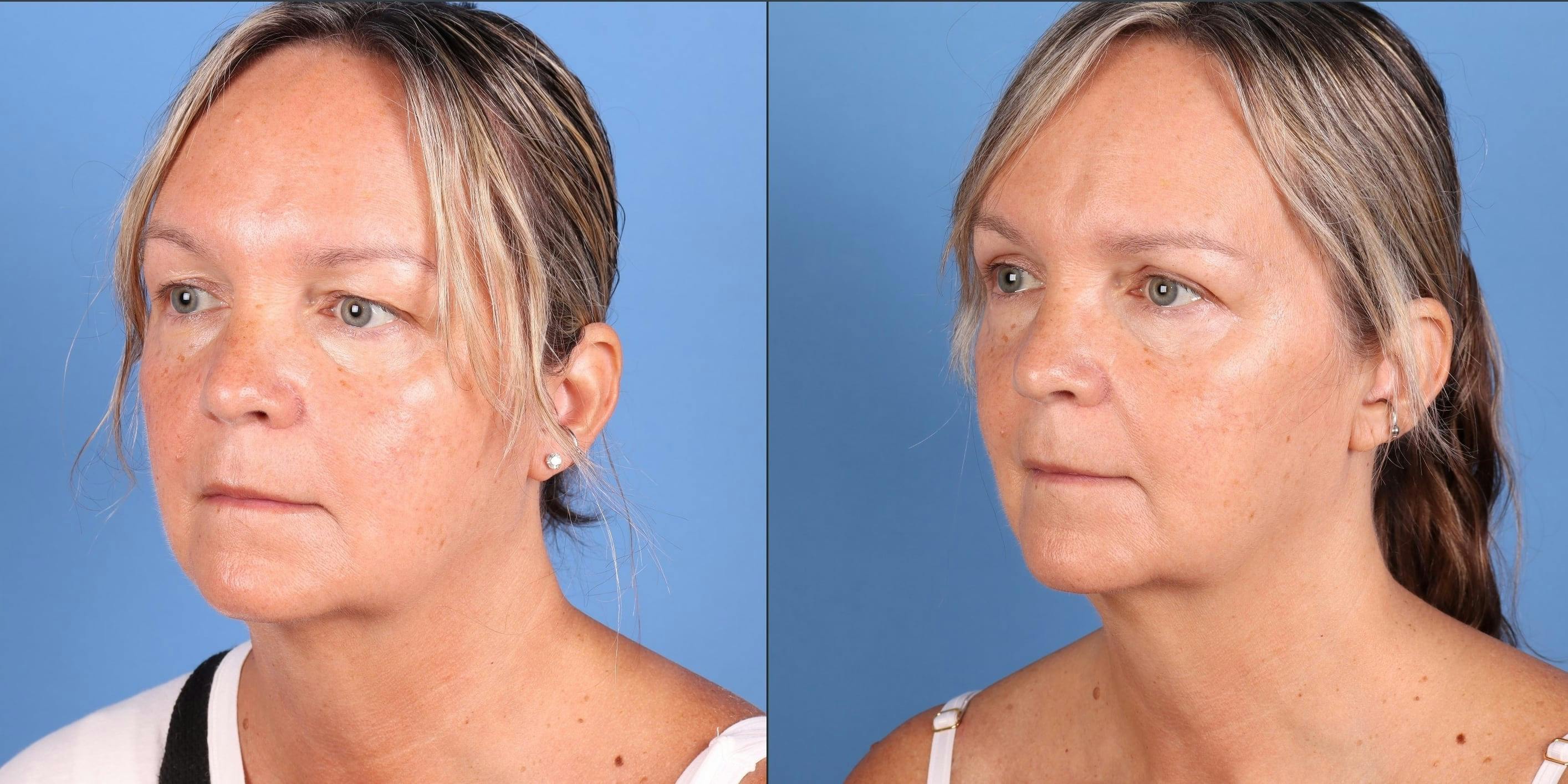 Eyelid Surgery (Upper Blepharoplasty) Before & After Gallery - Patient 178096 - Image 3
