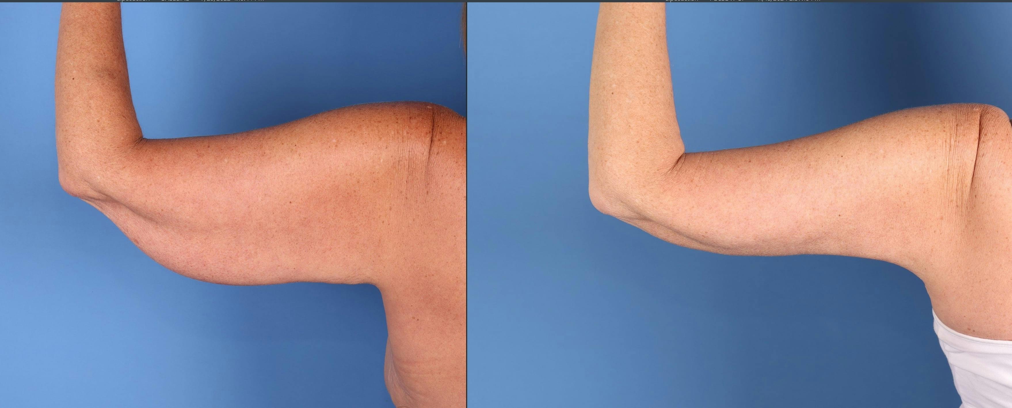 Arm Lift Before & After Gallery - Patient 308731 - Image 3