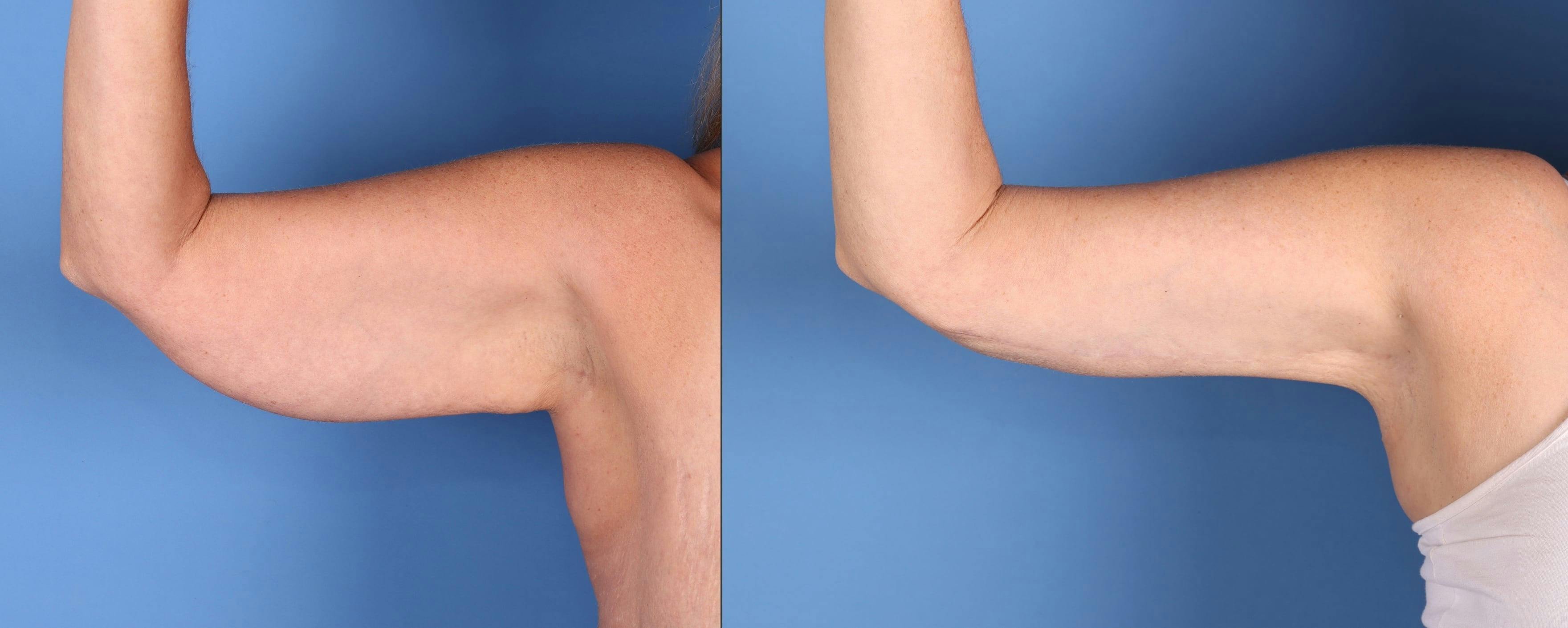Arm Lift Before & After Gallery - Patient 308731 - Image 1