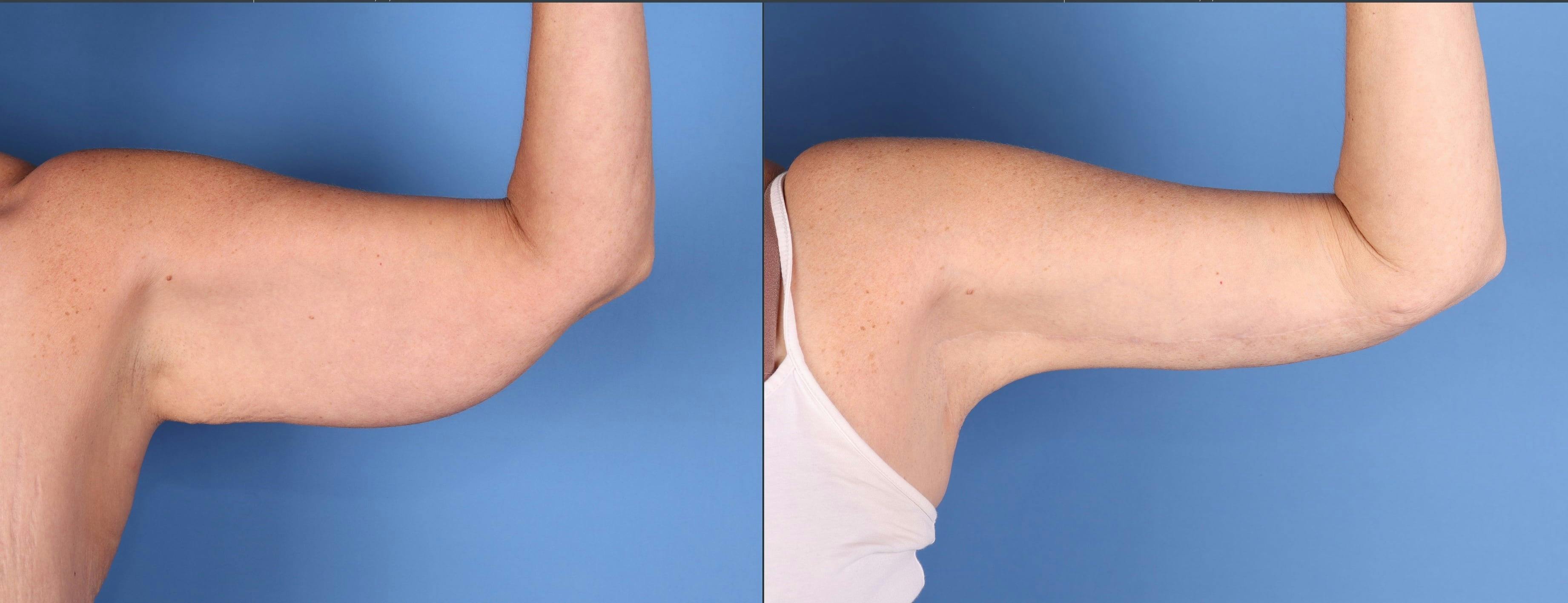 Arm Lift Before & After Gallery - Patient 308731 - Image 2