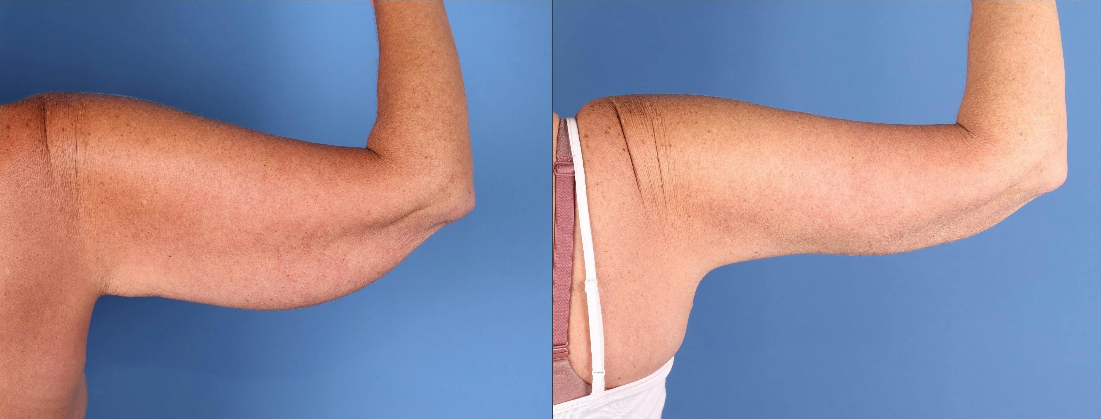 Arm Lift Before & After Gallery - Patient 308731 - Image 4