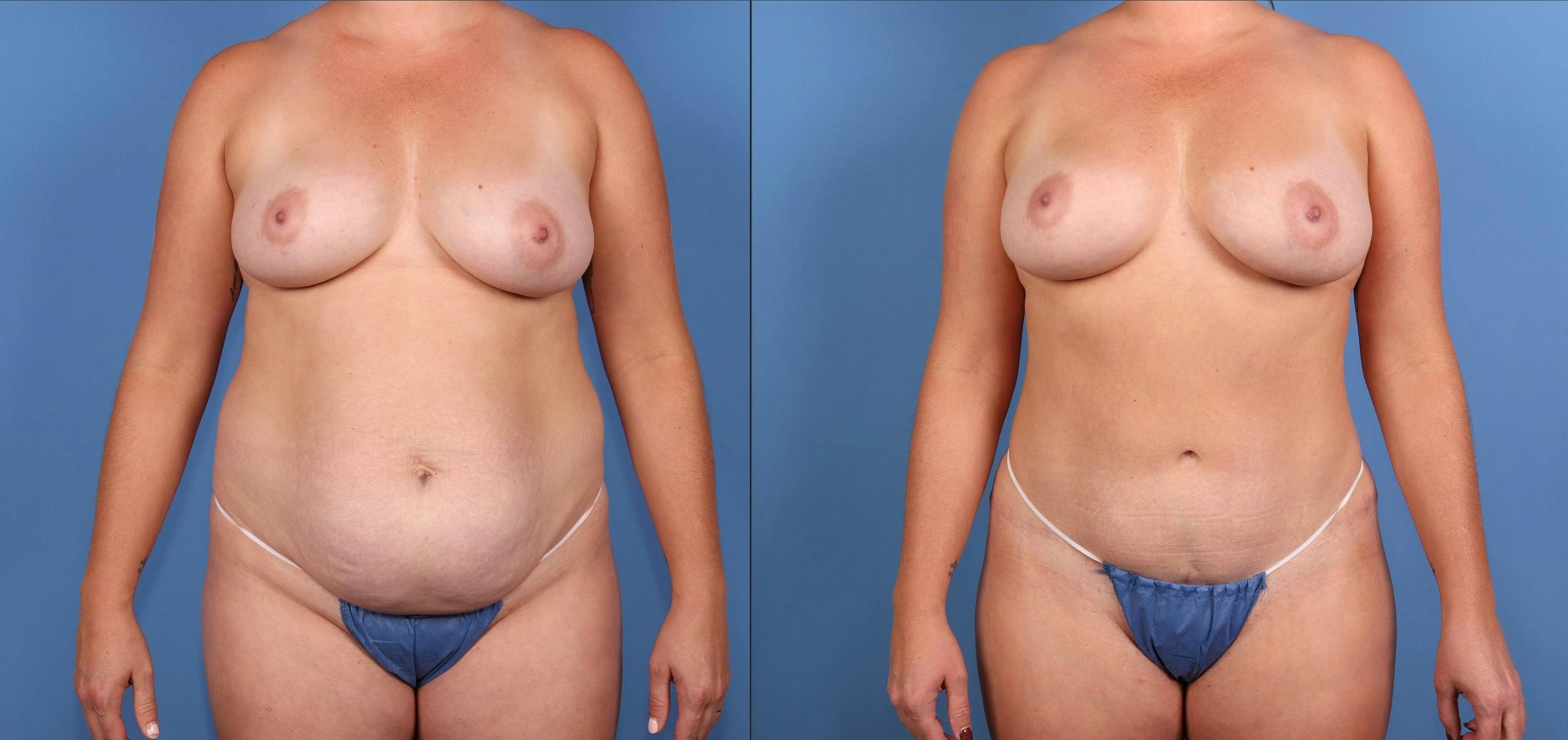 Mommy Makeover Before & After Gallery - Patient 380019 - Image 1