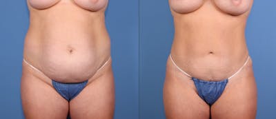 Tummy Tuck Before & After Gallery - Patient 307550 - Image 1