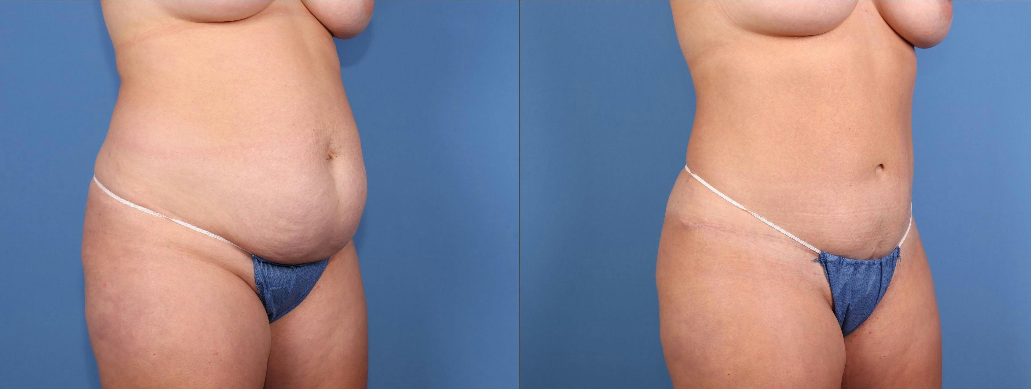 Tummy Tuck Before & After Gallery - Patient 307550 - Image 2