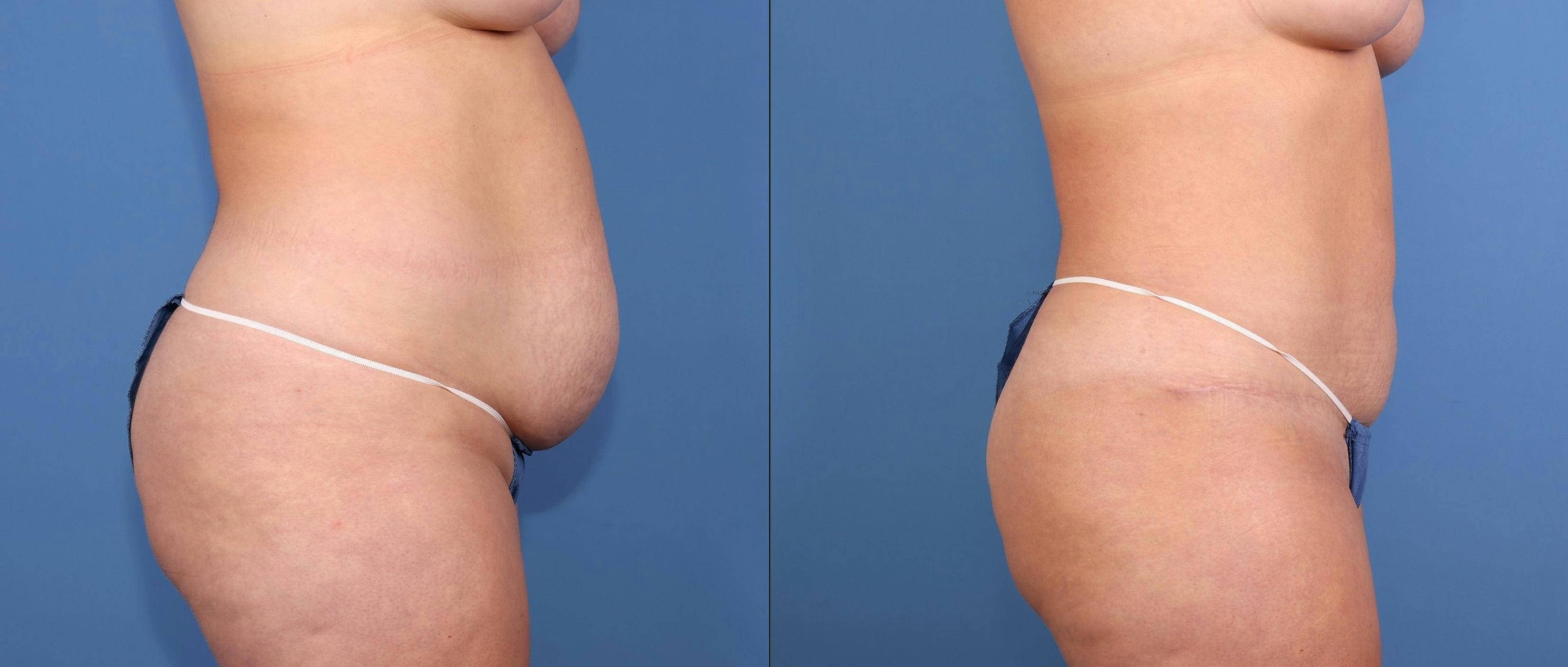Tummy Tuck Before & After Gallery - Patient 307550 - Image 3