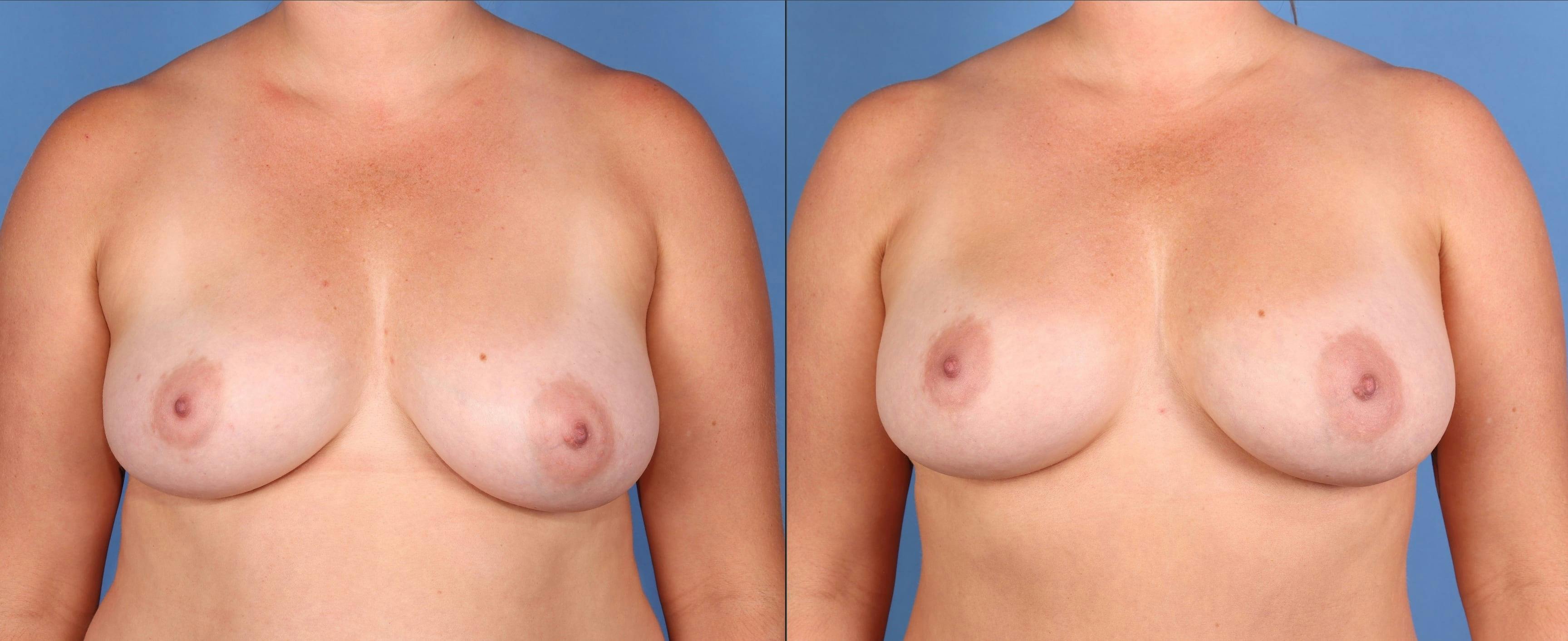 Fat Transfer Breast Augmentation Before & After Gallery - Patient 156928 - Image 1