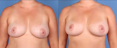 Fat Transfer Breast Augmentation Before & After Gallery - Patient 156928 - Image 1