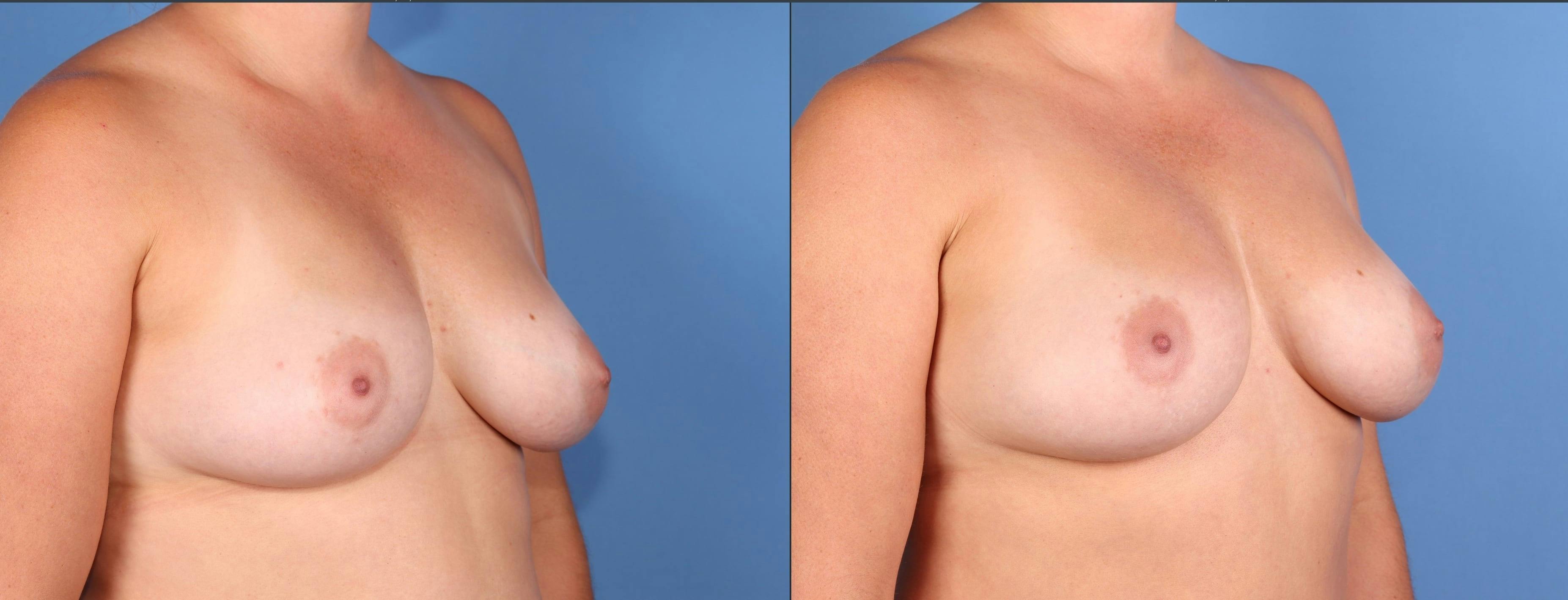 Fat Transfer Breast Augmentation Before & After Gallery - Patient 156928 - Image 5
