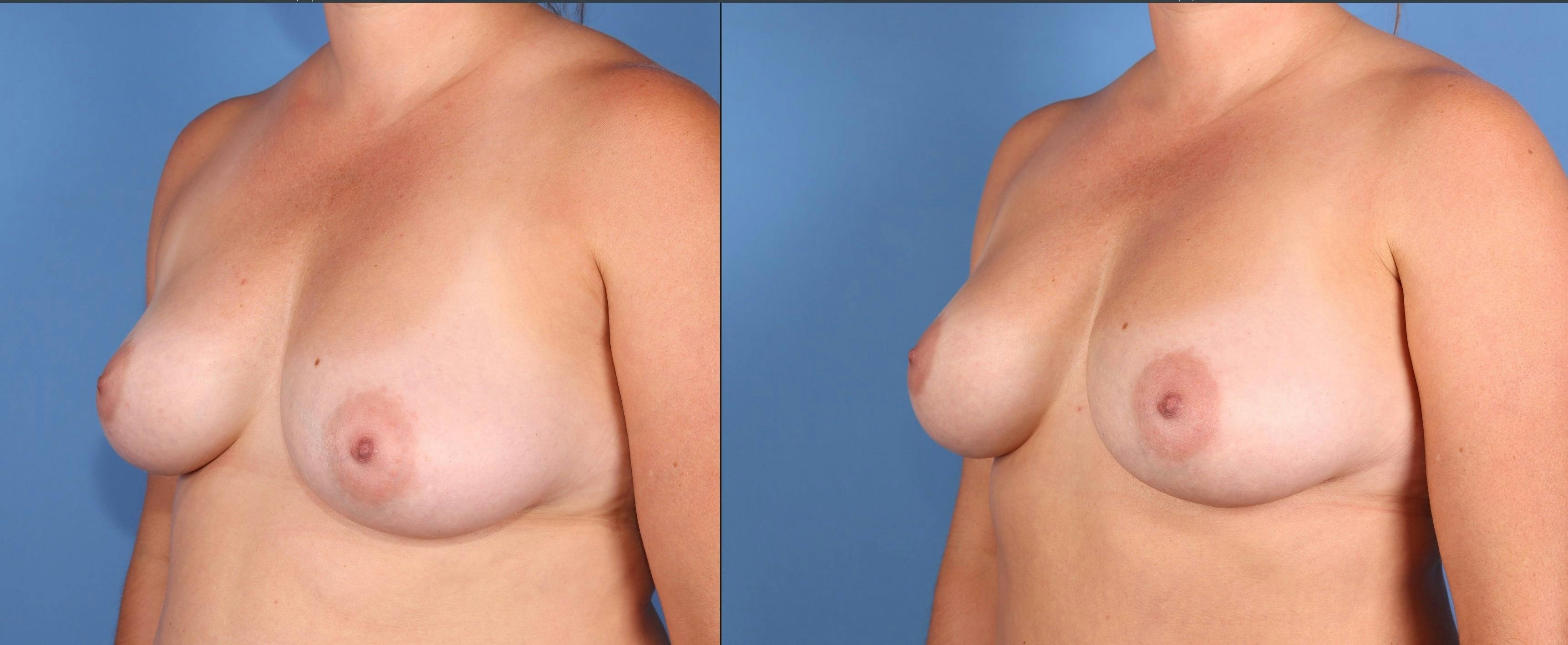 Fat Transfer Breast Augmentation Before & After Gallery - Patient 156928 - Image 2