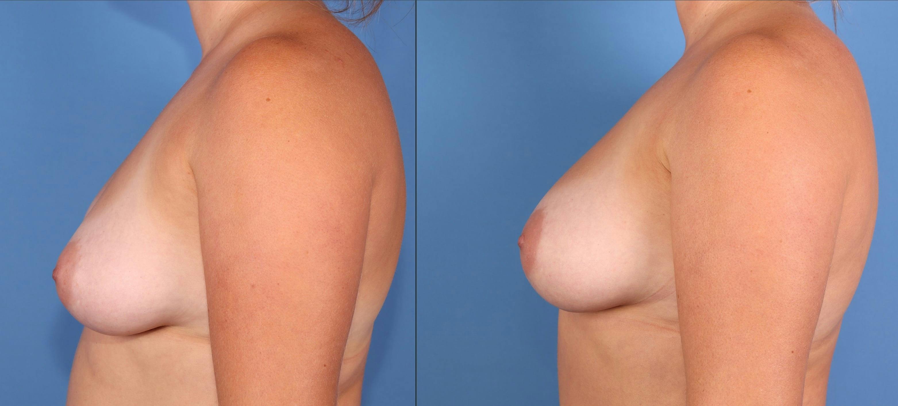 Fat Transfer Breast Augmentation Before & After Gallery - Patient 156928 - Image 3