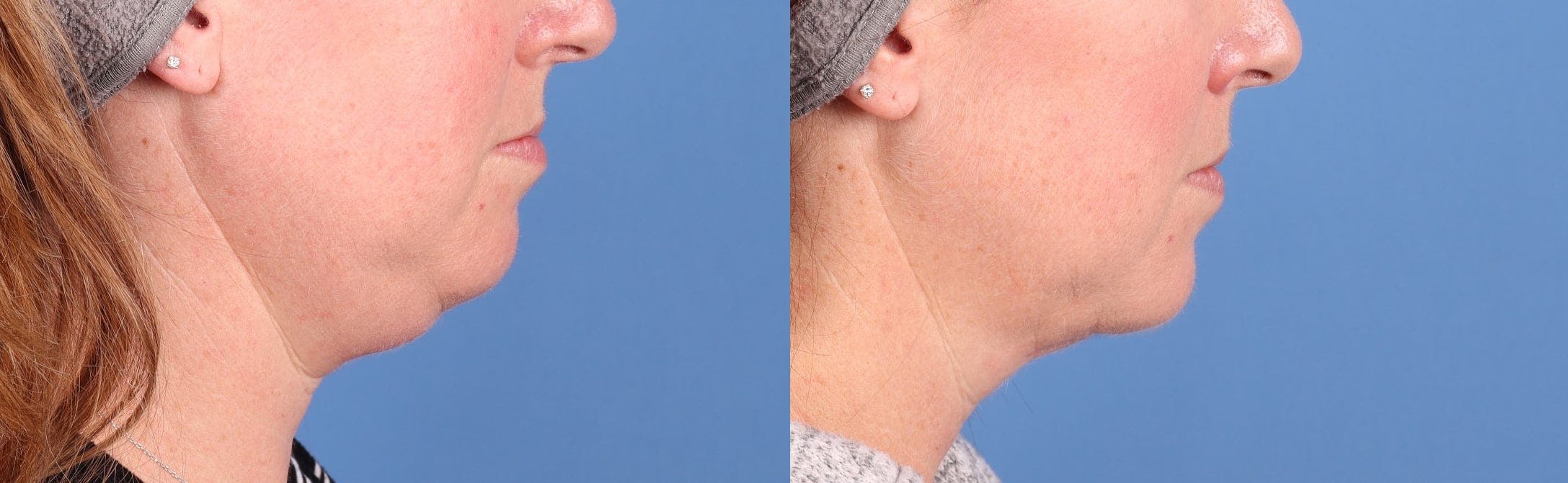 Face & Neck Before & After Gallery - Patient 286522 - Image 2