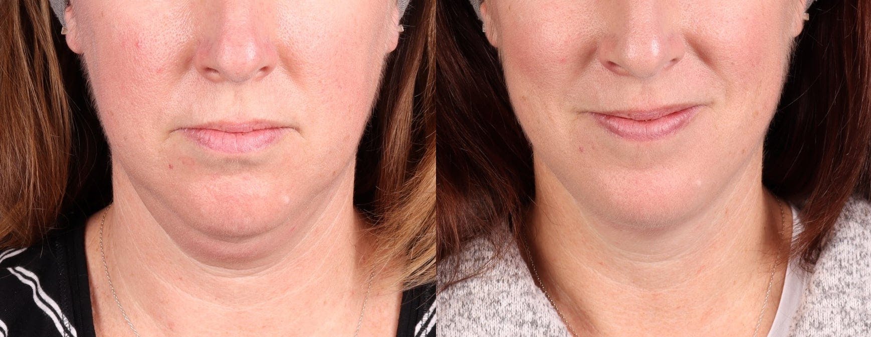 Face & Neck Before & After Gallery - Patient 286522 - Image 1