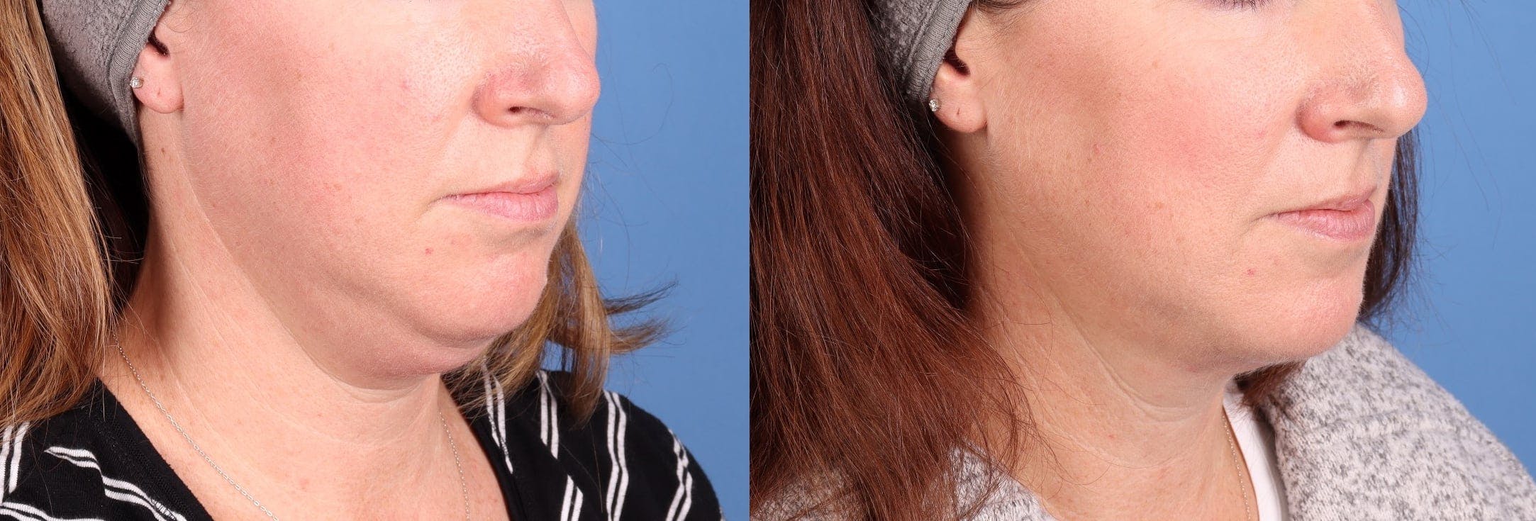 Face & Neck Before & After Gallery - Patient 286522 - Image 3