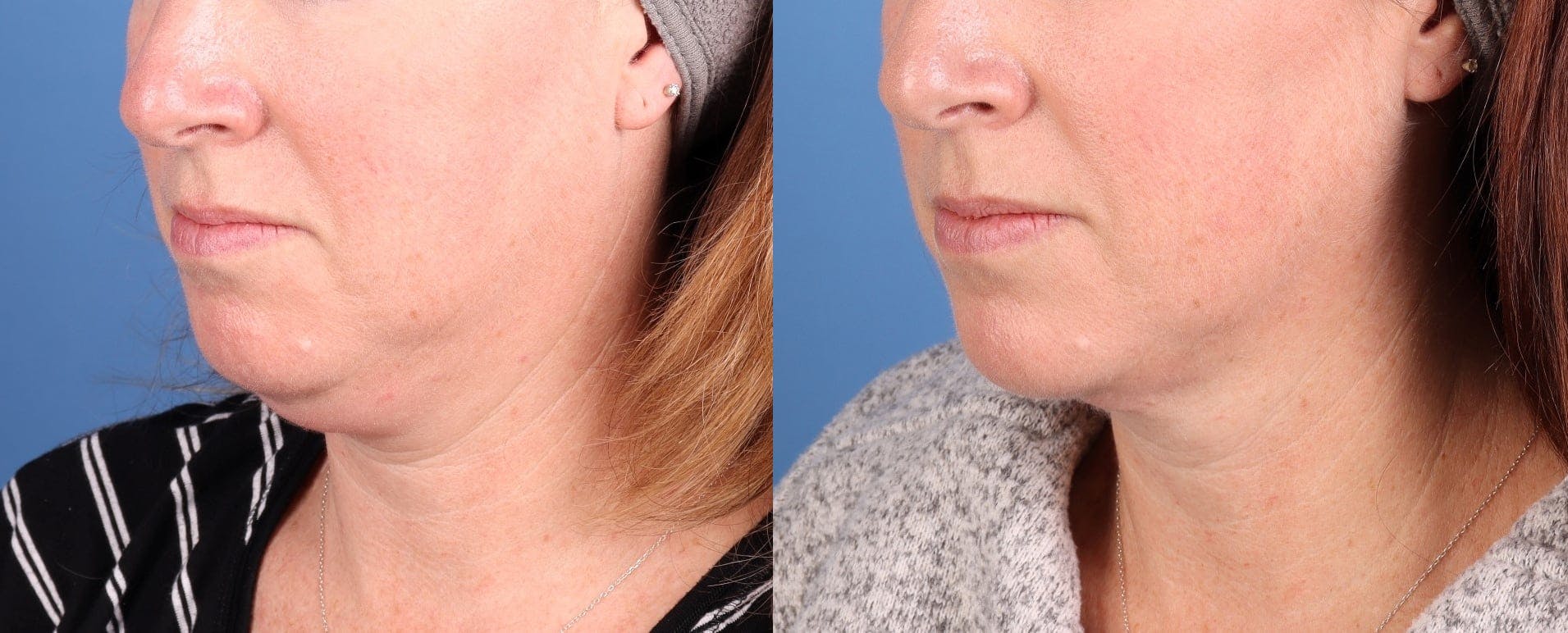 Face & Neck Before & After Gallery - Patient 286522 - Image 4