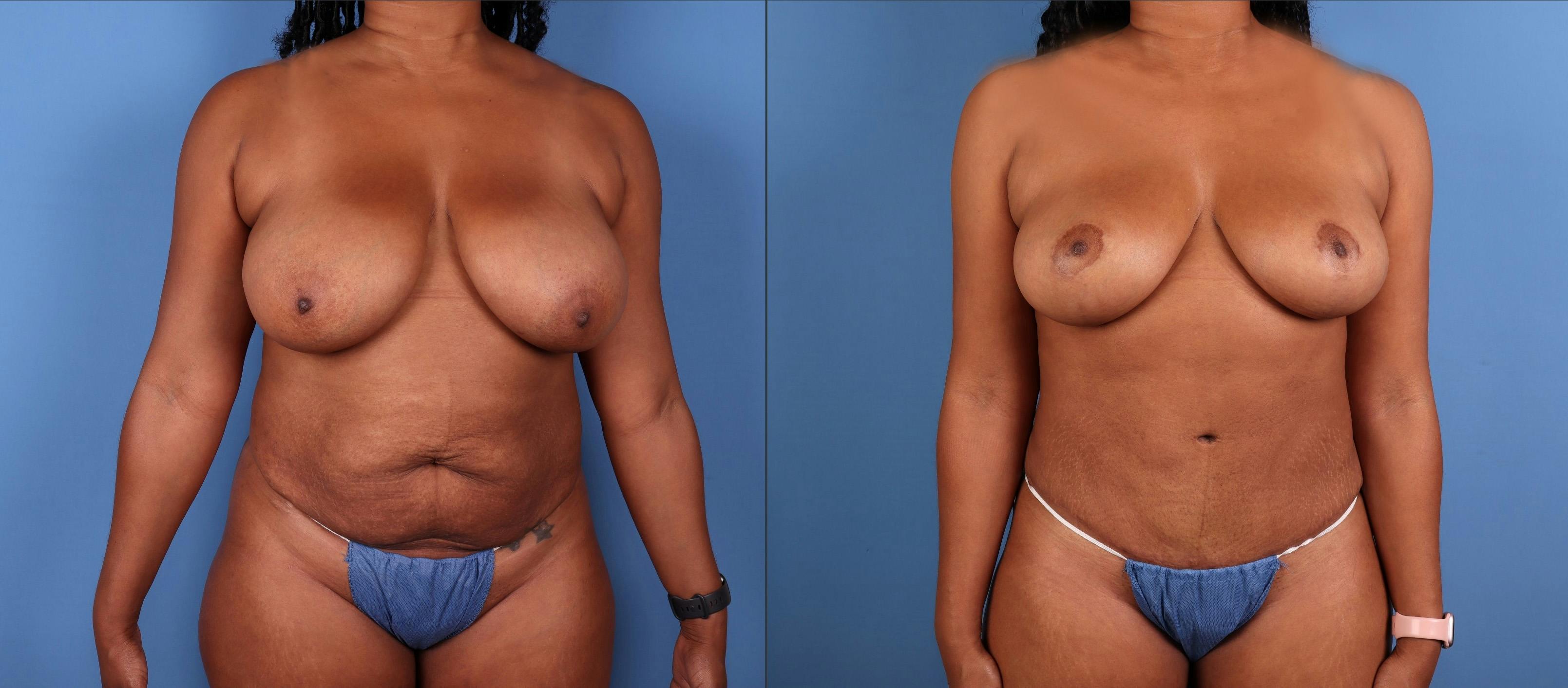 Mommy Makeover Before & After Gallery - Patient 835008 - Image 1
