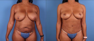 Mommy Makeover Before & After Gallery - Patient 835008 - Image 1