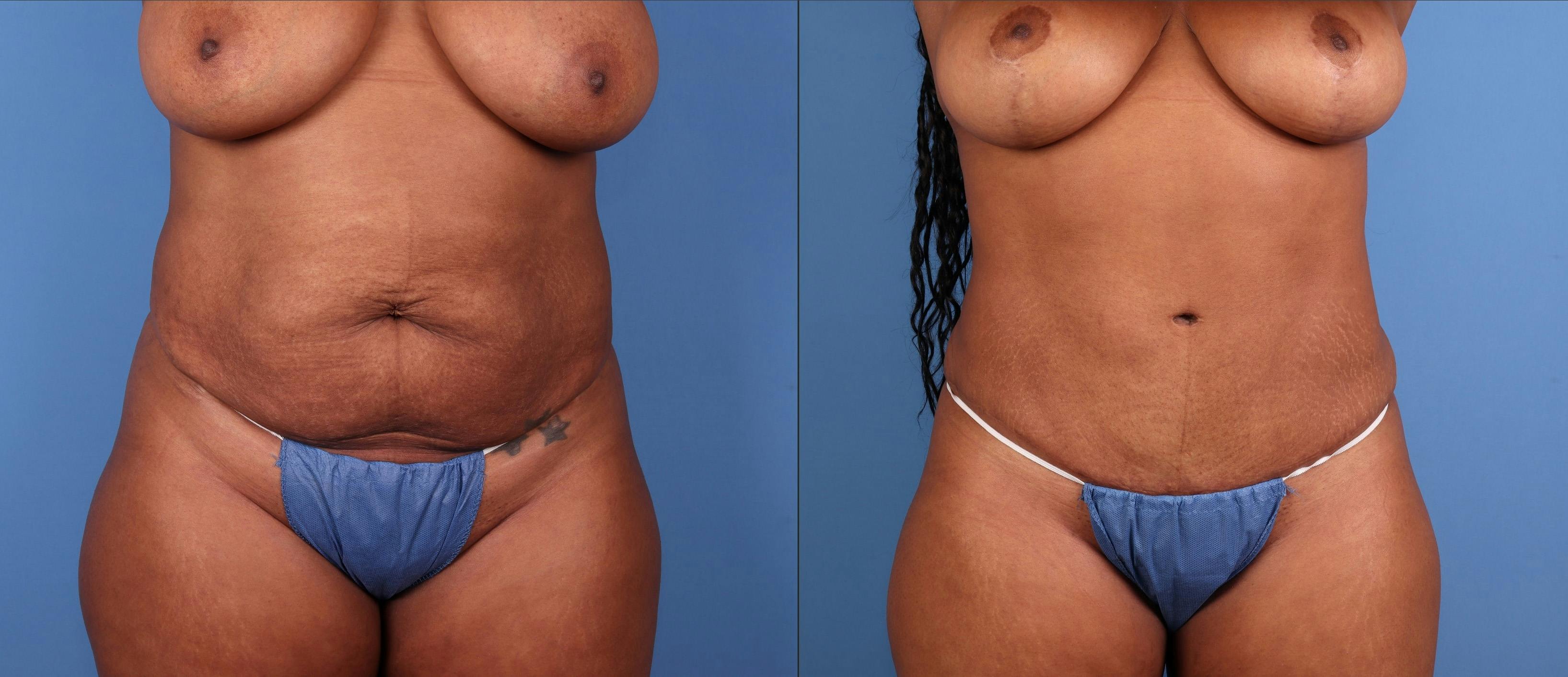 Tummy Tuck Before & After Gallery - Patient 378557 - Image 1